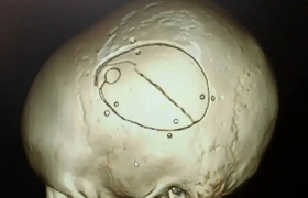 В Кемерово пятилетний ребёнок получил перелом ч...